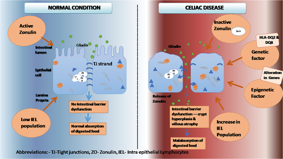 understanding-the-genetic-basis-of-celiac-disease:-a-comprehensive-review-|-cell-biochemistry-and-biophysics-–-springer