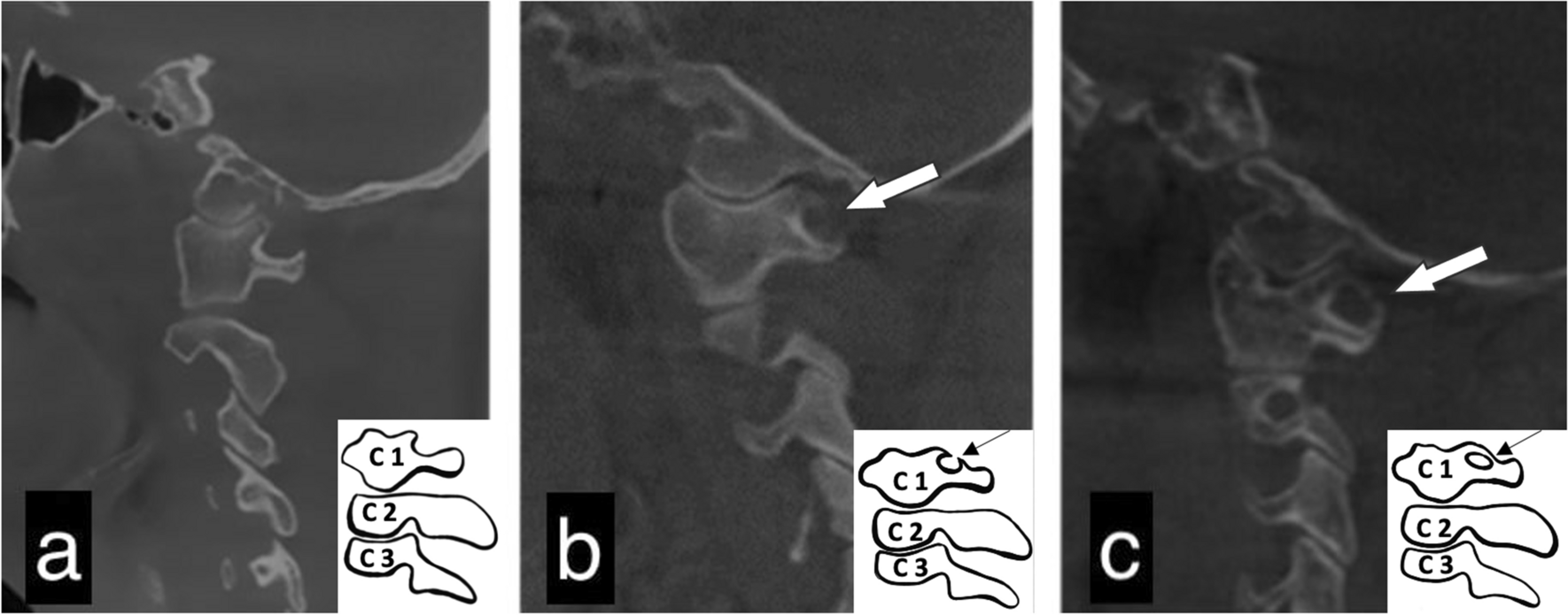 retrospective-evaluation-of-ponticulus-posticus-prevalence,-sella-turcica-types,-and-stylohyoid-complex-calcifications-in-…-–-springer