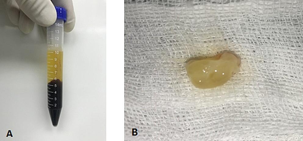 platelet-rich-fibrin-augmented-tympanoplasty-versus-cartilage-tympanoplasty:-a-randomized-clinical-trial-–-springer